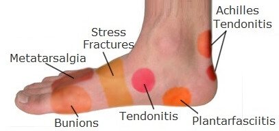 Image result for foot pain
